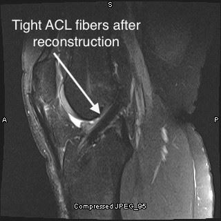 Intact ACL after reconstruction