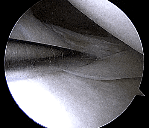 meniscus image